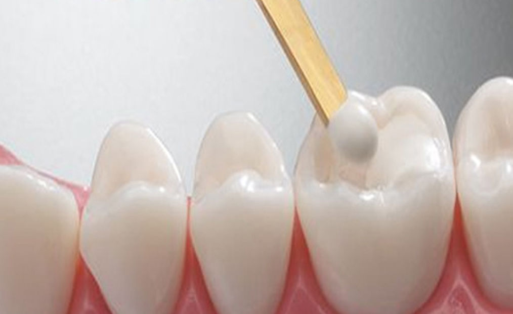 white-tooth-fillings.jpg